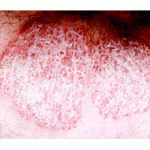 02-20-2009-plaque-psoriasis