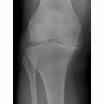 02-26-2009-Knee-OA