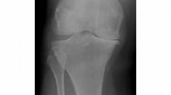 02-26-2009-Knee-OA