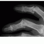 04-03-2009-psoriatic-arthritis