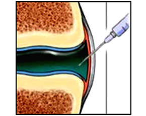 Steroid injection knee aafp