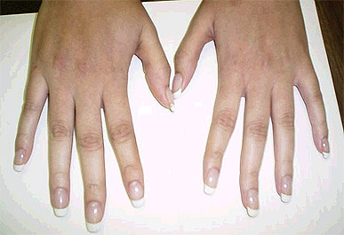 Still Disease