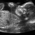 5-24-2010-leflunomide