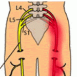 8-18-2010-sciatica