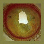 Coronary-Artery