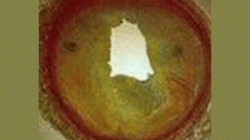 Coronary-Artery