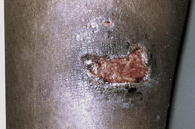 Case 9 - Figure 2 Blister