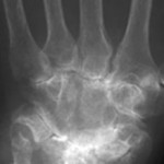 denosumab
