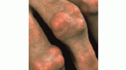 gout-08-10-02