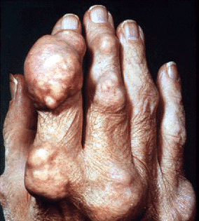 Images Of Gout