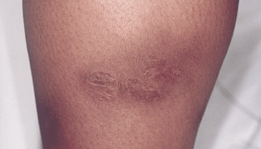 Case 9 - Figure 3 Healed