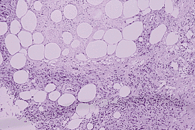 Case 0 - Figure 1 Histology