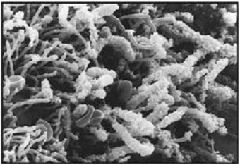 Biofilm on the tooth of a patieth with periodontitis.
