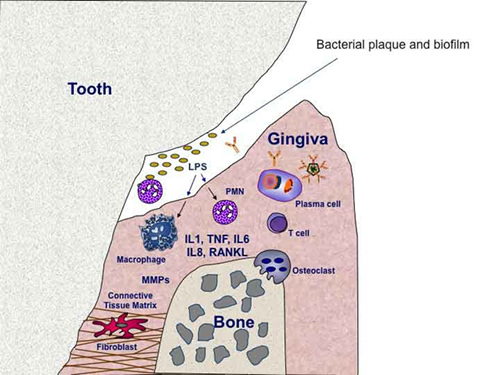 Rheumatoid Arthritis Pathology