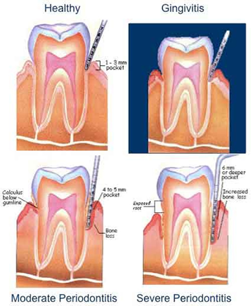 Gingivitis Vs Periodontitis
