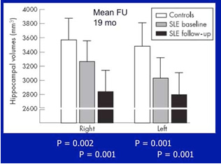 Atrophy in Hippocampus in SLE
