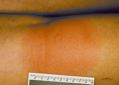 Erythema migrans