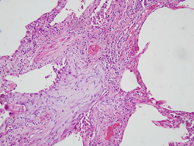 fibroblastic foci on open lung biopsy