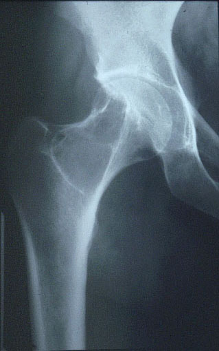 Hip Swelling