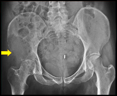bone metastatic disease treatment metastases osteolytic metastasis round ct scan arthritis shows when common below