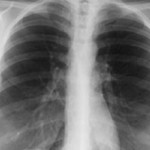 Chest X-Ray