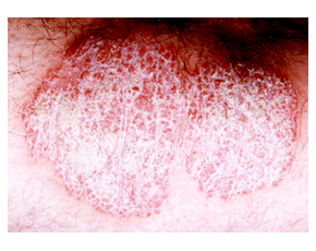 Plaque Psoriasis