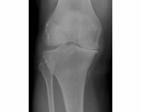 Chondroitin Sulfate May Act as a Structure Modifying Agent in Knee Osteoarthritis