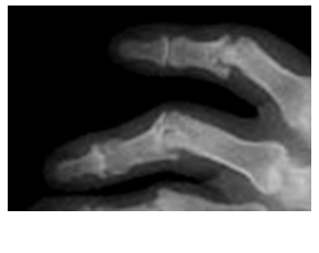 Arthritis Mutilans in a Patient with Psoriatic Arthritis