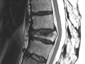 MR Image Showing a Thoracic Vertebral Compression Fracture