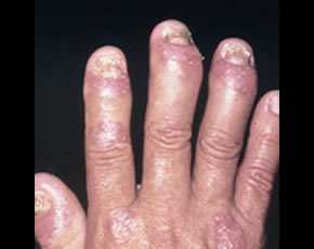 Rheumatoid Vasculitis