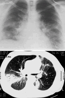 bronchiolitis obliterans paru pneumonia interstitial organizing rheumatoid desquamative perokok boop obliterative arthritis radang betekenis mantan peradangan kronis lebenserwartung yahya