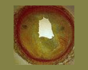 Coronary Artery with Atherosclerosis