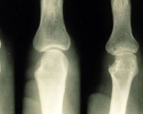 Rheumatoid Arthritis