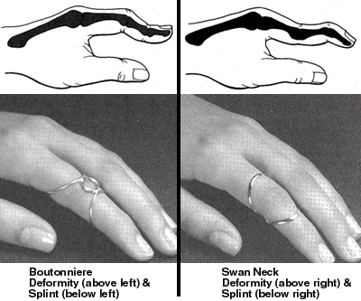 sketch of swan neck and boutonnier deformities in the hand pictured with cooresponding corrective orthoses