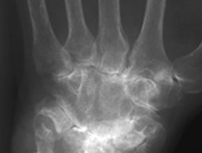 Figure: Advanced erosive disease of the wrist in a patient with RA