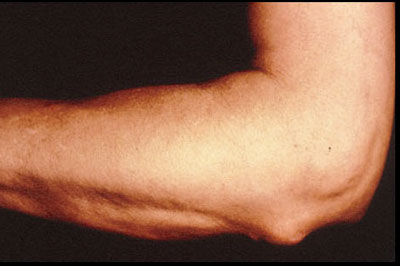 Rheumatoid Nodules