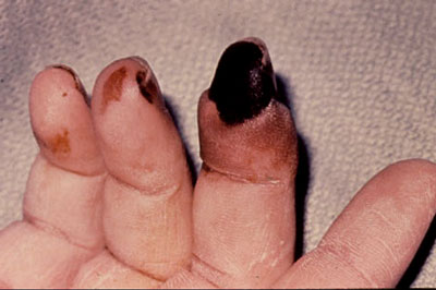 Rheumatoid Vasculitis in Rheumatoid Arthritis Patient