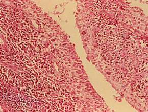 Rheumatoid Synovitis