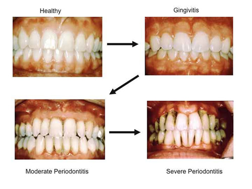 Round 34 Periodontal Disease and Rheumatoid Arthritis • Arthritis