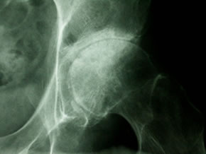 What is osteoarthritis of the hip?