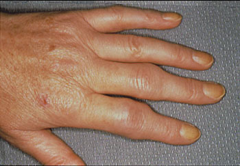 rheuma arthritis finger