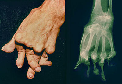 Advanced deformity in the hand from Rheumatoid Arthritis