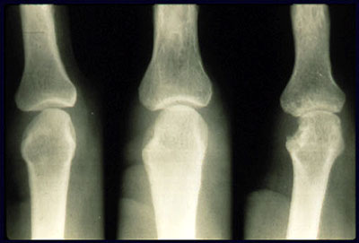 Erosion of the joints from Rheumatoid Arthritis