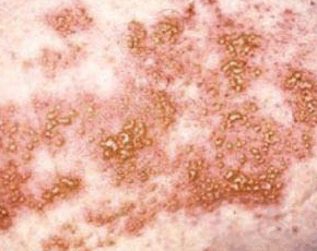 Figure: Cutaneous Zoster Outbreak