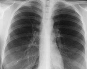 Challenges in Screening for Latent TB in Inflammatory Arthritis